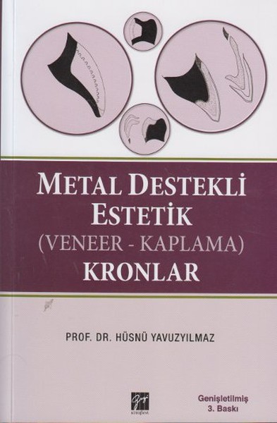 Metal Destekli Estetik VeneerKaplama Kronlar